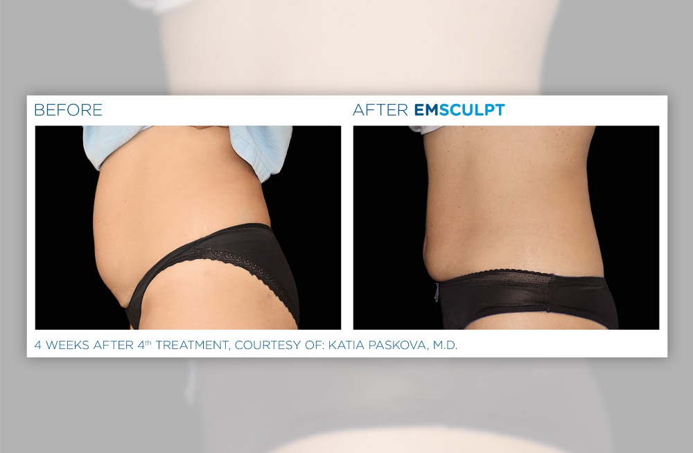 The Exclusive EMSCULPT® Provider in the Upper Valley - Peraza Dermatology  Group
